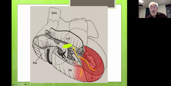 Tachycardies Ventriculaires-Tutorat Lecture ECG 2021-Pr Michel Chauvin