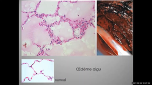 Pathologie pulmonaire non-tumorale