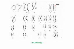 5. Anomalies de structure des chromosomes-ORTHOPTIE