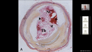 Pathologie cardiaque