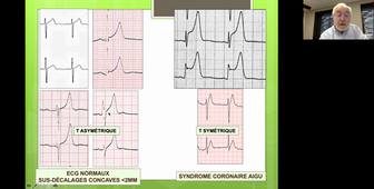 Pericardite aigue-dyskaliemie-calcemie-cardiomyopathie -Tutorat Lecture ECG 2021-Pr Michel Chauvin