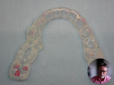 Occlusodontie traitement des DCM