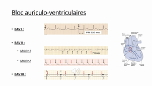 Troubles de la conduction