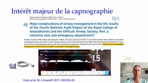 Intubation difficile (Pottecher)