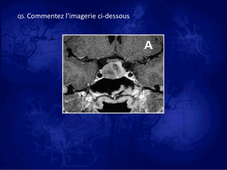 TD N°6 « Adénome hypophysaire » - Cas Clinique 2